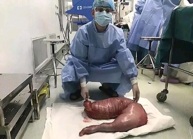 Doctors Removed 13 Kilograms of Waste From a Young Man’s Stomach After Years of Mystery Pain